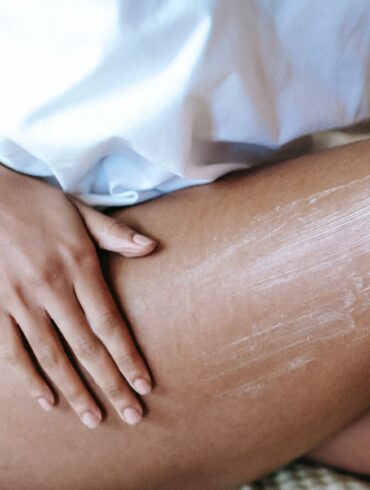 Smagliature: cosa le causa e come eliminarle Smagliature: cosa le causa e come eliminarle