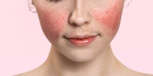 Rosacea: Cause, Sintomi e Trattamenti