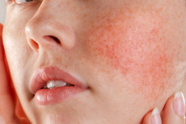 Rosacea: Cause, Sintomi e Trattamenti