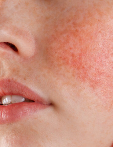 Rosacea: Cause, Sintomi e Trattamenti