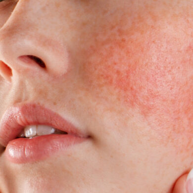 Rosacea: Cause, Sintomi e Trattamenti