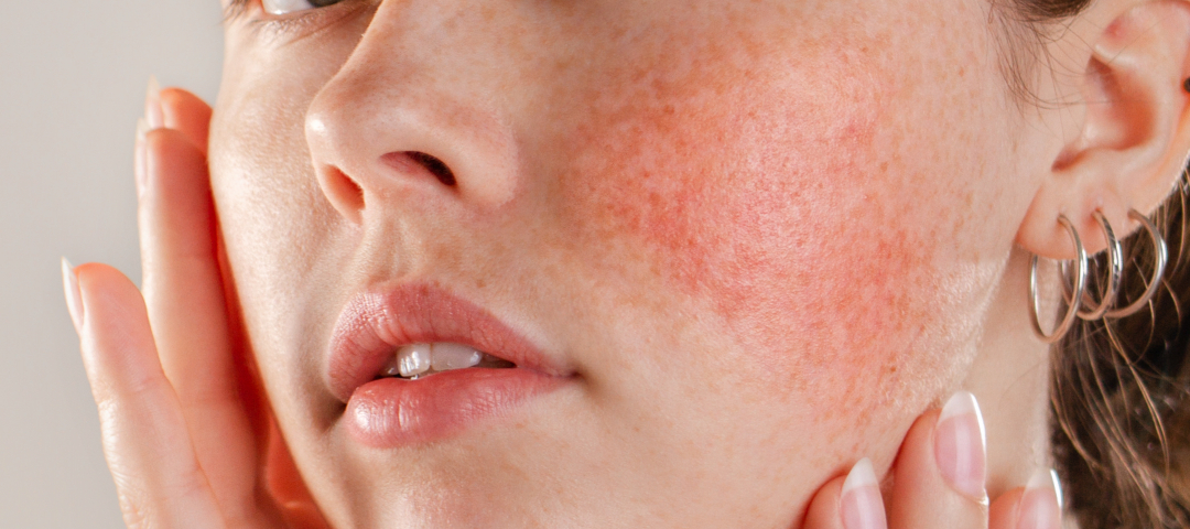 Rosacea: Cause, Sintomi e Trattamenti