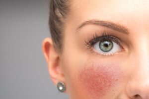 Rosacea: Cause, Sintomi e Trattamenti